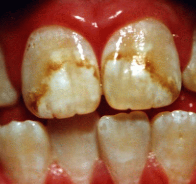 Fluorosis present in 41% of US teenagers