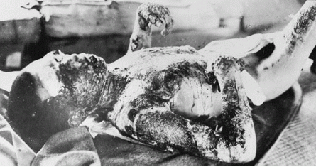 Figure 2: A Hiroshima Bombing Burn Victim