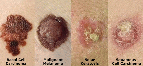 Figure 2. Types of skin cancer, where my 1/2-inch -wide cancer was non-mlaignant but looked like the malignant melanoma.